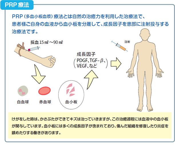 PRP療法