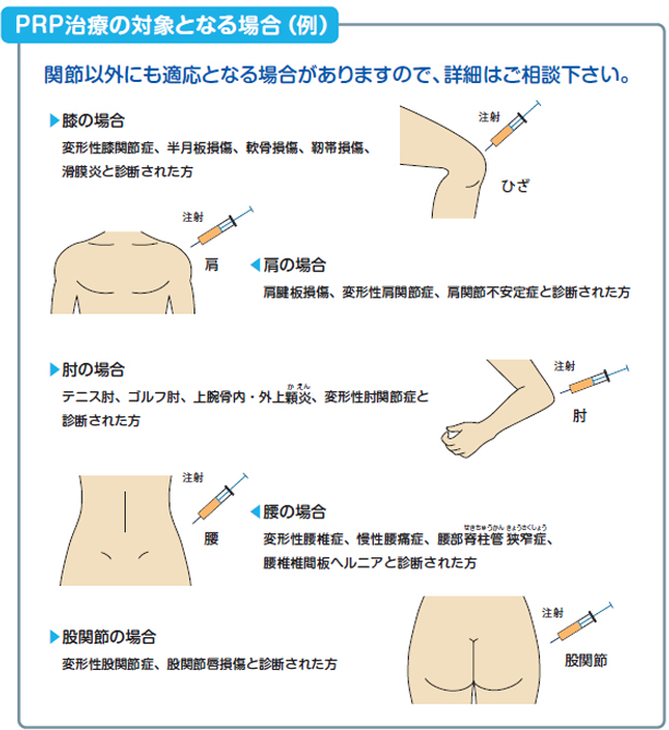 PRP治療の対象となる場合（例）